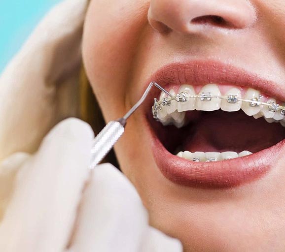 Ceramic Braces Adelaide - Clear Orthodontics - Orthodontic Smile Practice