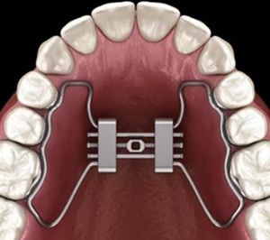 Types of Orthodontic Appliances - Perfect Smiles Orthodontics